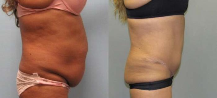 Before & After Tummy Tuck Case 124 View 2 View in Savannah, GA