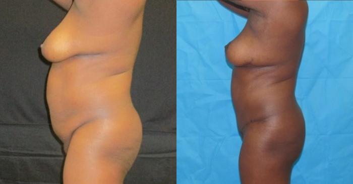 Before & After Tummy Tuck Case 125 View 2 View in Savannah, GA