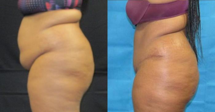 Before & After Tummy Tuck Case 126 View 2 View in Savannah, GA