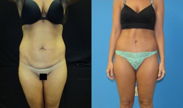 Before & After Tummy Tuck Case 127 View 1 View in Savannah, GA