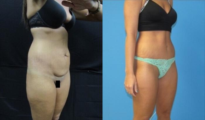 Before & After Tummy Tuck Case 127 View 2 View in Savannah, GA