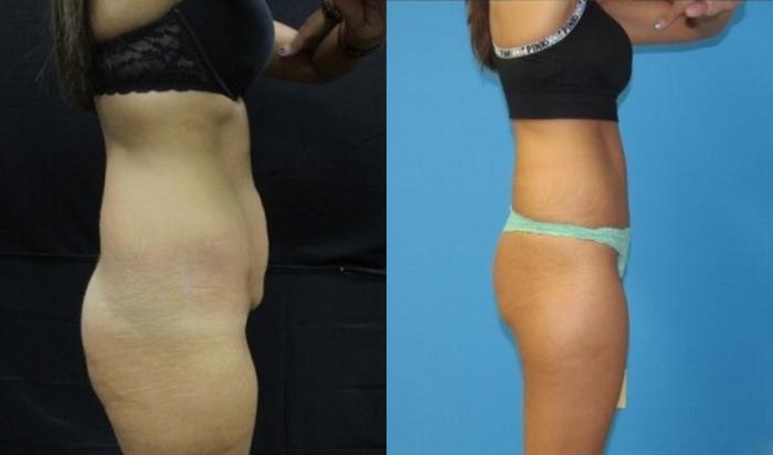 Before & After Tummy Tuck Case 127 View 3 View in Savannah, GA