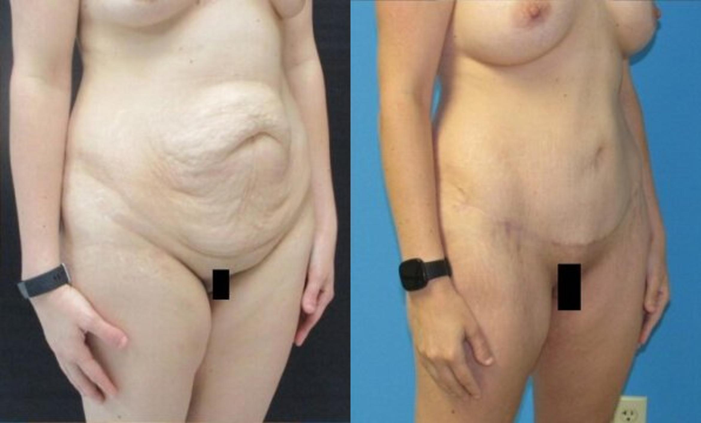 Before & After Tummy Tuck Case 128 View 2 View in Savannah, GA