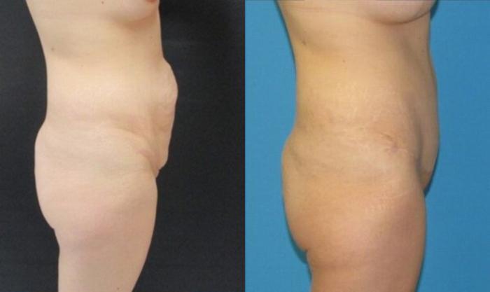 Before & After Tummy Tuck Case 128 View 3 View in Savannah, GA