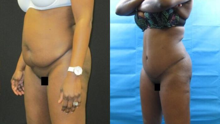 Before & After Tummy Tuck Case 129 View 2 View in Savannah, GA