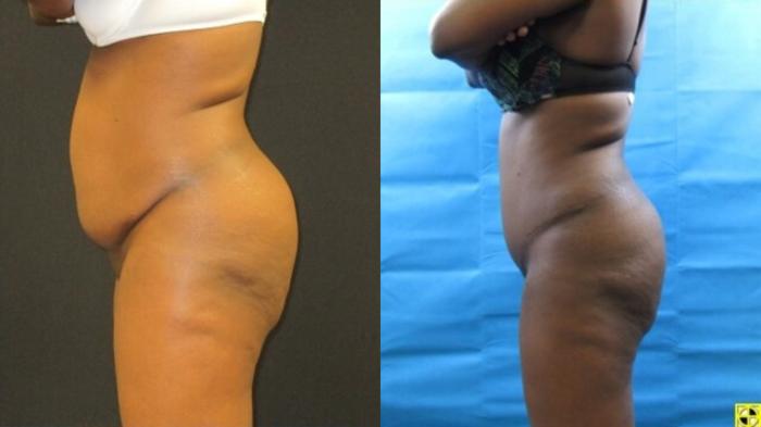 Before & After Tummy Tuck Case 129 View 3 View in Savannah, GA