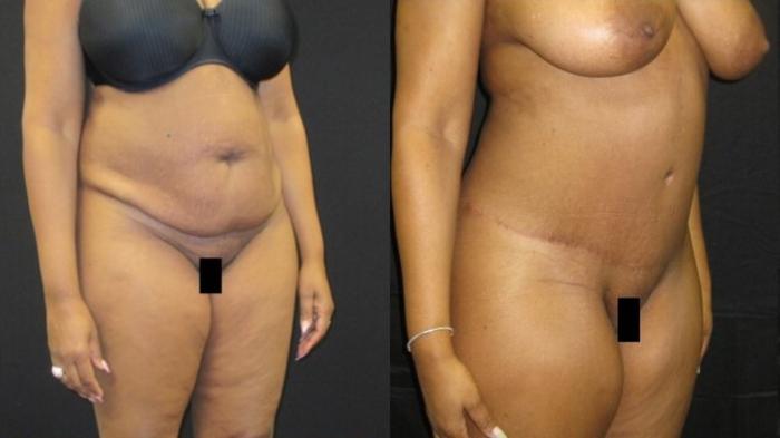 Before & After Tummy Tuck Case 130 View 2 View in Savannah, GA