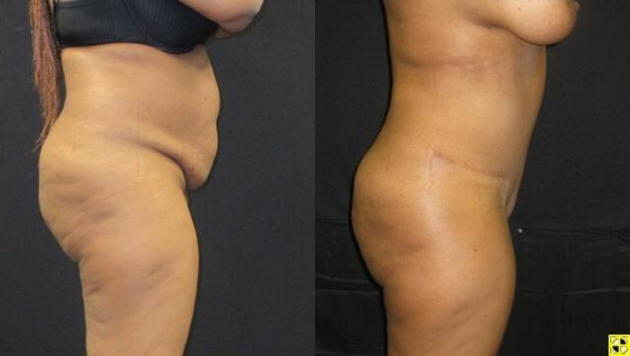Before & After Tummy Tuck Case 130 View 3 View in Savannah, GA