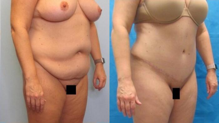 Before & After Tummy Tuck Case 132 View 2 View in Savannah, GA