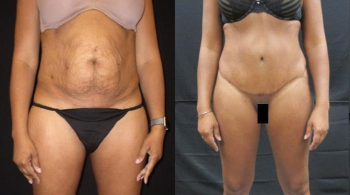 Before & After Tummy Tuck Case 134 View 1 View in Savannah, GA