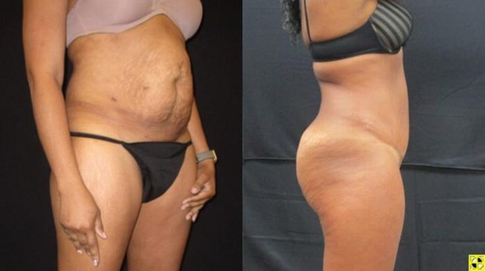 Before & After Tummy Tuck Case 134 View 2 View in Savannah, GA