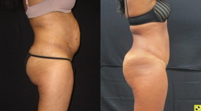 Before & After Tummy Tuck Case 134 View 3 View in Savannah, GA