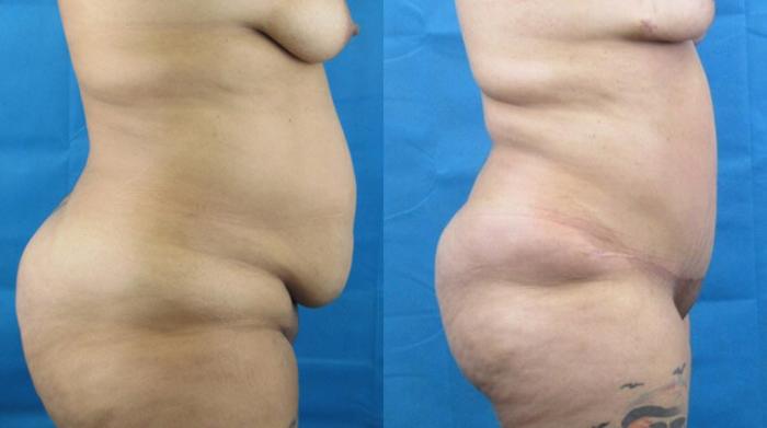 Before & After Tummy Tuck Case 135 View 2 View in Savannah, GA
