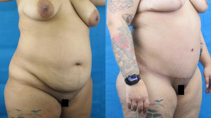 Before & After Tummy Tuck Case 135 View 3 View in Savannah, GA
