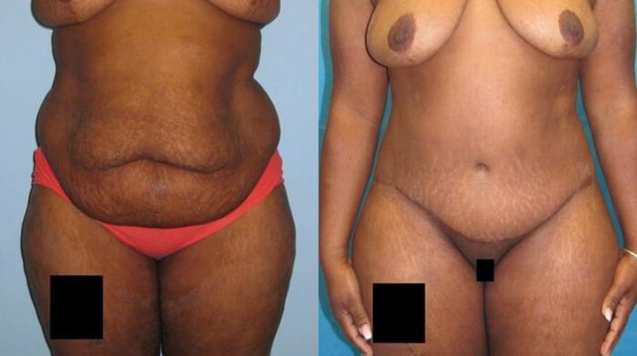 Before & After Tummy Tuck Case 136 View 1 View in Savannah, GA