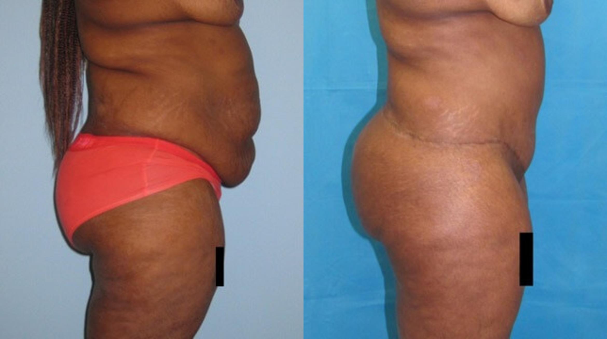 Before & After Tummy Tuck Case 136 View 2 View in Savannah, GA