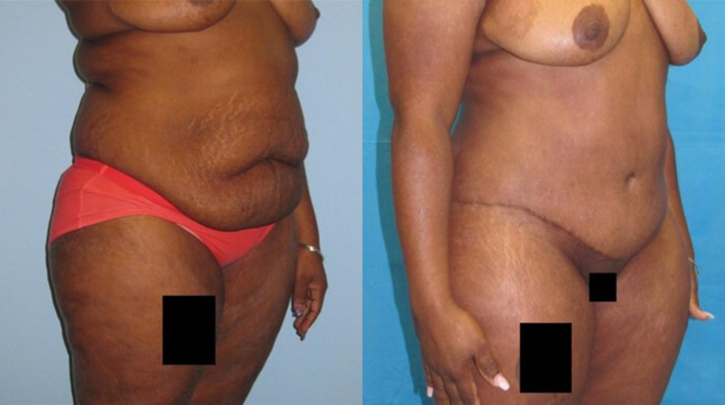 Before & After Tummy Tuck Case 136 View 3 View in Savannah, GA
