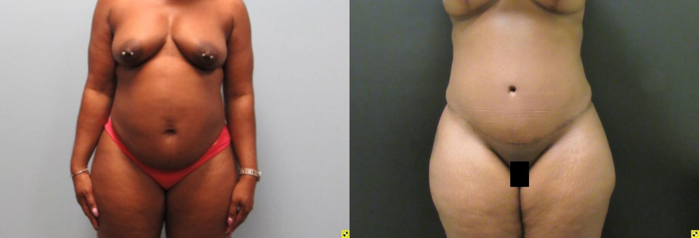 Before & After Tummy Tuck Case 137 View 1 View in Savannah, GA