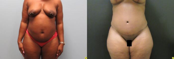 Before & After Tummy Tuck Case 137 View 1 View in Savannah, GA