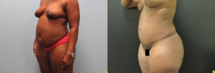 Before & After Tummy Tuck Case 137 View 2 View in Savannah, GA