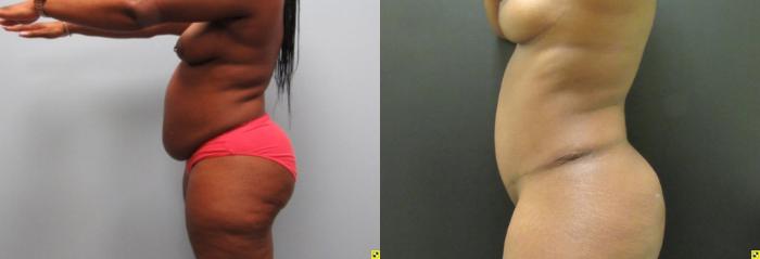 Before & After Tummy Tuck Case 137 View 3 View in Savannah, GA