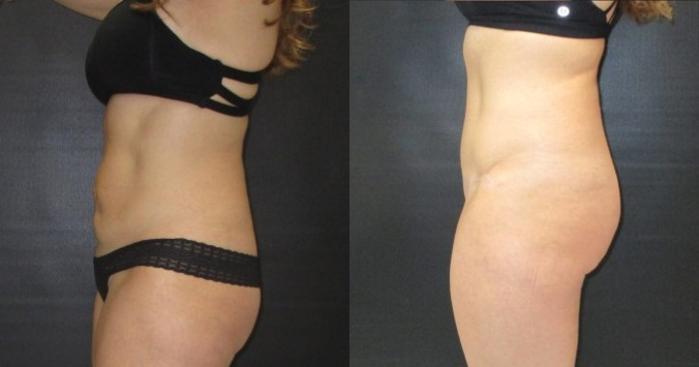 Before & After Tummy Tuck Case 141 View 2 View in Savannah, GA