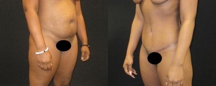Before & After Tummy Tuck Case 142 View 2 View in Savannah, GA