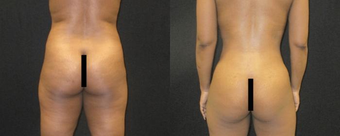Before & After Tummy Tuck Case 142 View 3 View in Savannah, GA