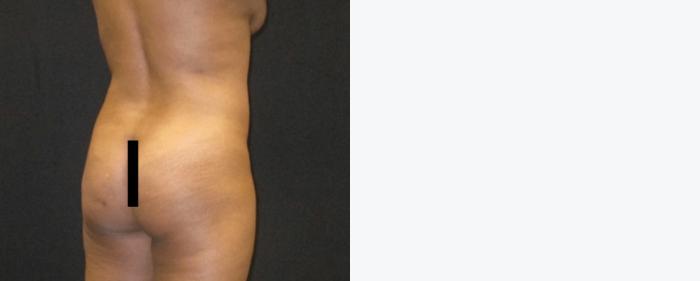Before & After Tummy Tuck Case 142 View 4 View in Savannah, GA