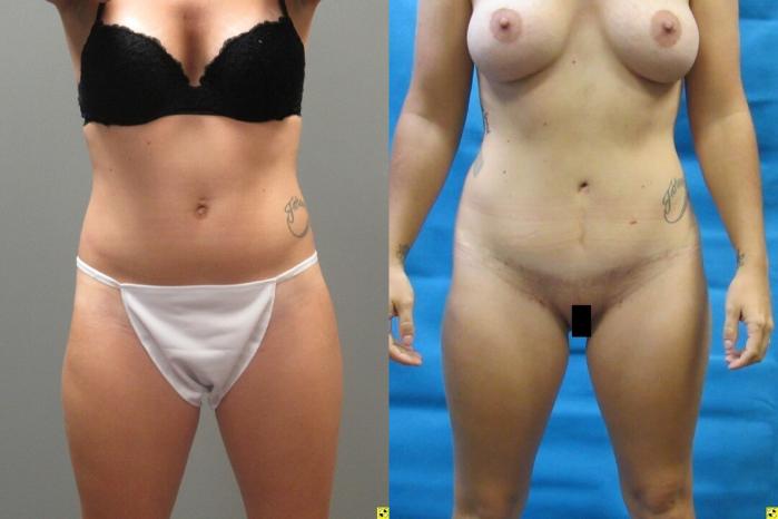 Before & After Tummy Tuck Case 146 View 1 View in Savannah, GA