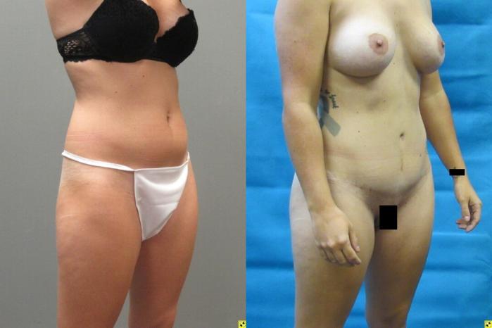 Before & After Tummy Tuck Case 146 View 2 View in Savannah, GA