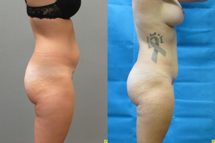 Before & After Tummy Tuck Case 146 View 3 View in Savannah, GA