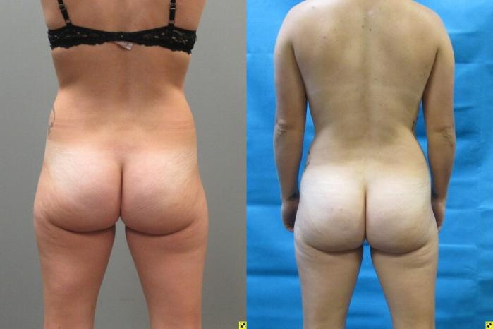 Before & After Tummy Tuck Case 146 View 4 View in Savannah, GA