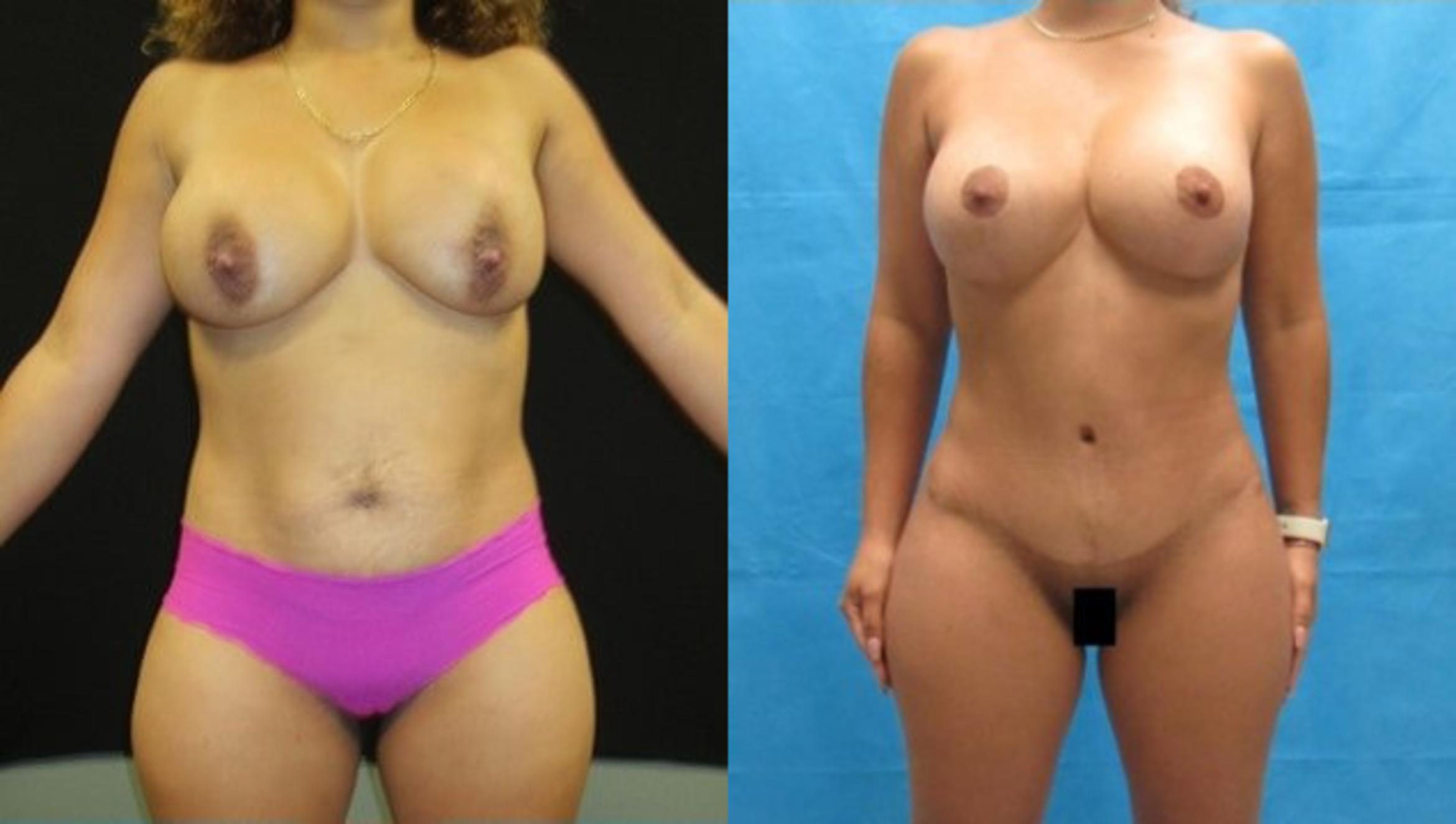 Before & After Tummy Tuck Case 148 View 1 View in Savannah, GA