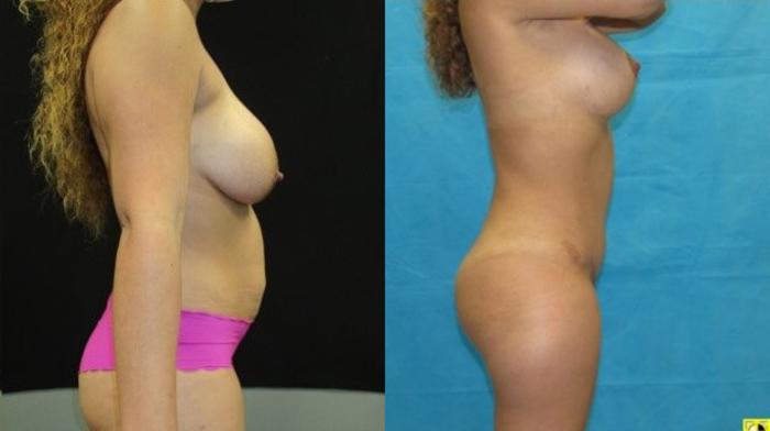 Before & After Tummy Tuck Case 148 View 3 View in Savannah, GA