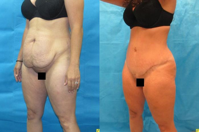 Before & After Tummy Tuck Case 151 View 2 View in Savannah, GA