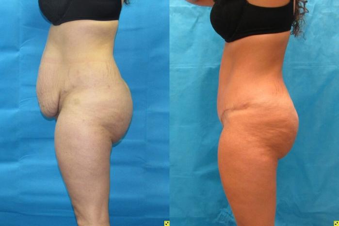Before & After Tummy Tuck Case 151 View 3 View in Savannah, GA