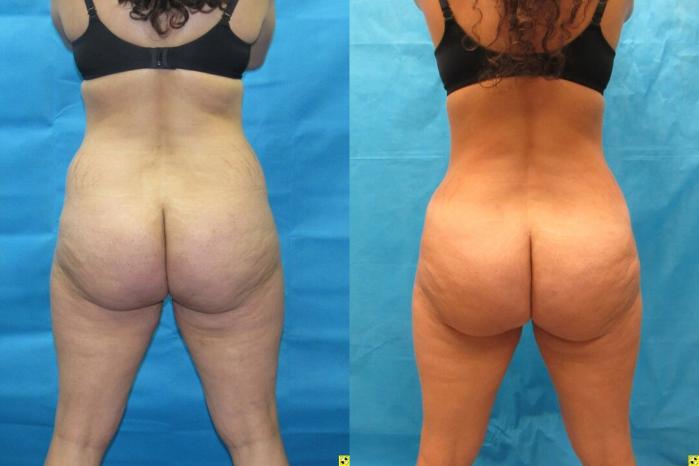 Before & After Tummy Tuck Case 151 View 4 View in Savannah, GA