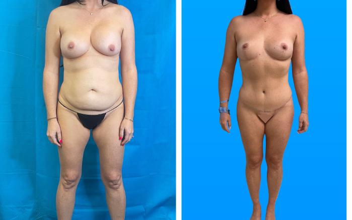 Before & After Tummy Tuck Case 156 Left Side View in Savannah, GA