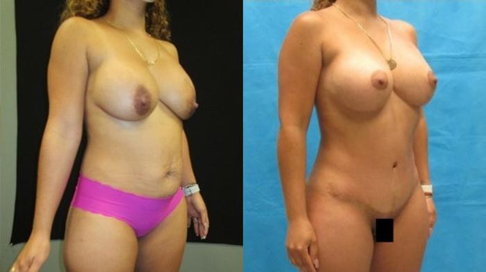Before & After Tummy Tuck Case 40 View 2 View in Savannah, GA