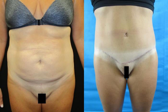 Before & After Tummy Tuck Case 61 View 1 View in Savannah, GA