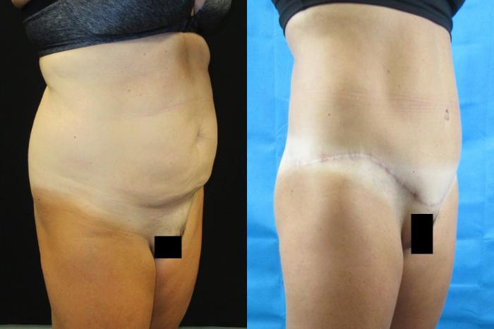 Before & After Tummy Tuck Case 61 View 2 View in Savannah, GA