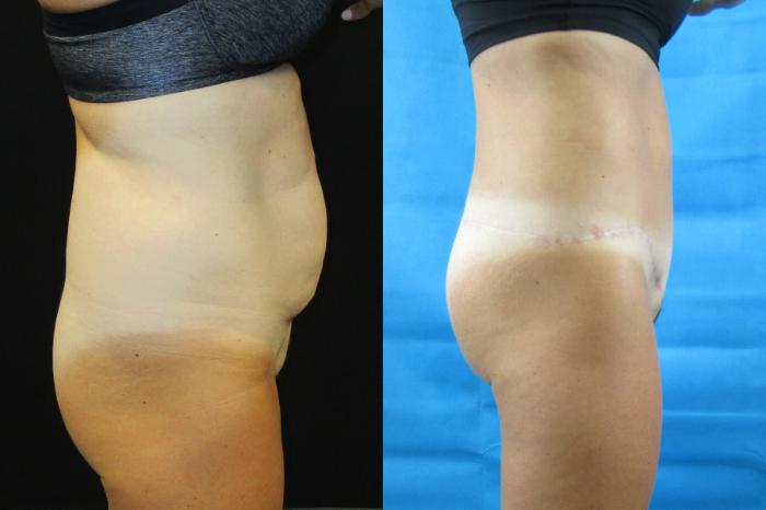 Before & After Tummy Tuck Case 61 View 3 View in Savannah, GA