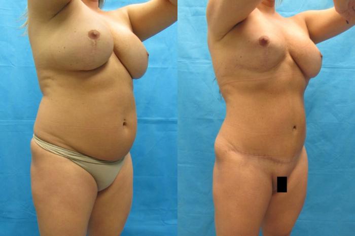 Before & After Tummy Tuck Case 64 View 2 View in Savannah, GA