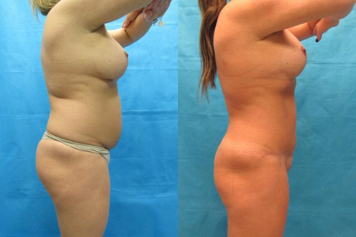Before & After Tummy Tuck Case 64 View 3 View in Savannah, GA