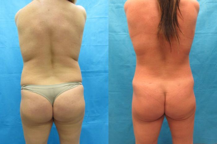 Before & After Tummy Tuck Case 64 View 4 View in Savannah, GA