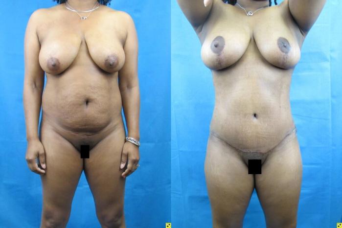 Before & After Tummy Tuck Case 74 View 1 View in Savannah, GA