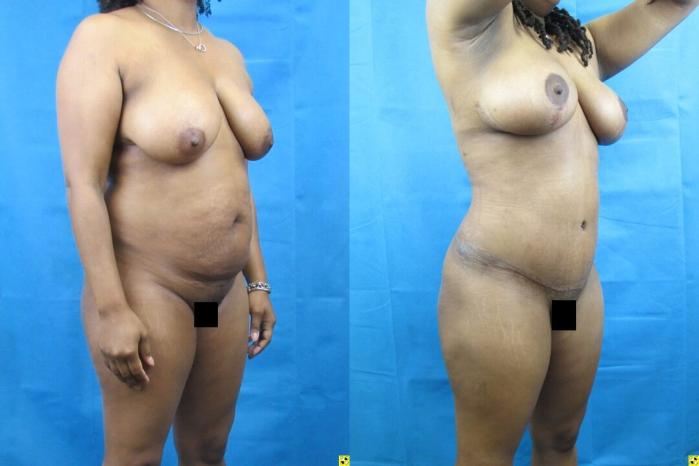 Before & After Tummy Tuck Case 74 View 2 View in Savannah, GA