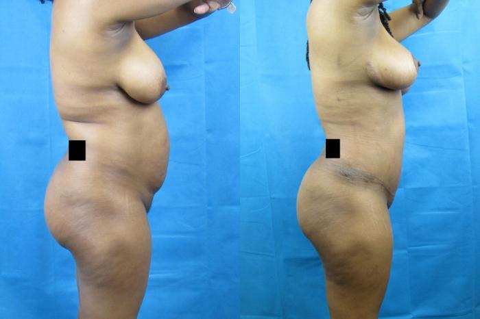 Before & After Tummy Tuck Case 74 View 3 View in Savannah, GA