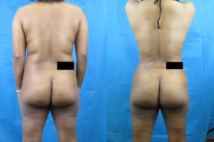 Before & After Tummy Tuck Case 74 View 4 View in Savannah, GA